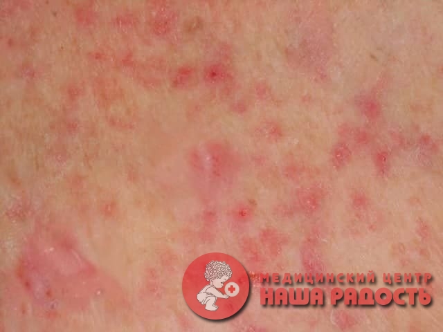 {"breadcrumbs":[{"label":"Статьи","url":["\/articles"]},"Потница у ребёнка: как выглядит и что делать"]}
